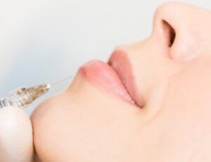 Verfahren zur Lippenunterspritzung